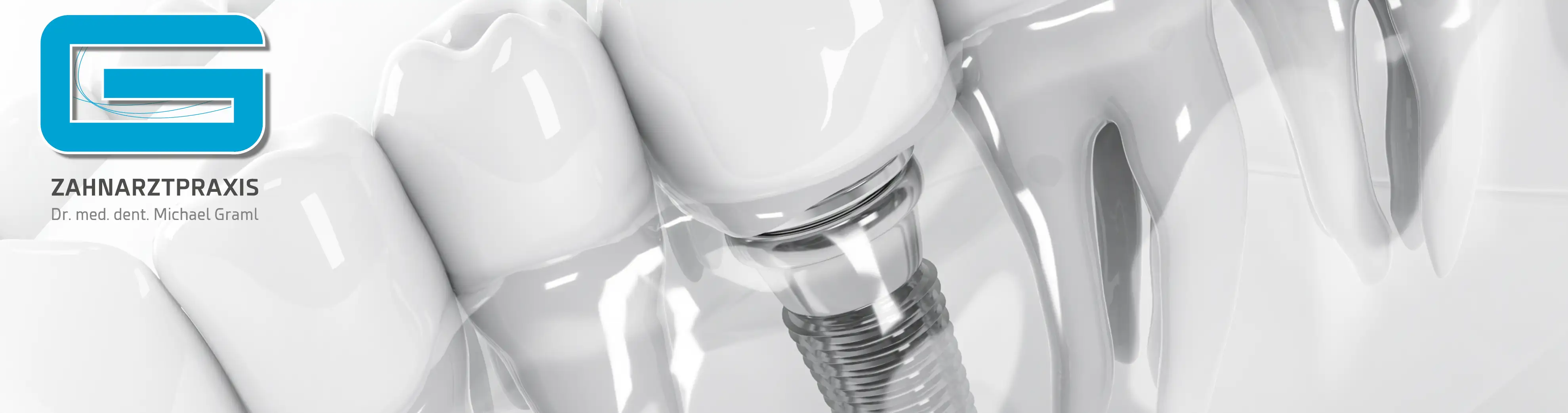 Das Bild zeigt ein 3D-Modell eines Zahnimplantats, das in den Kieferknochen eingesetzt ist. Das Implantat besteht aus einer Metallschraube, die tief in den Knochen eingebettet ist, um Stabilität zu bieten. Auf dieser Schraube ist eine Zahnkrone befestigt, die die Form und das Aussehen eines natürlichen Zahns nachbildet. Dieses Modell veranschaulicht, wie Zahnimplantate verwendet werden, um fehlende Zähne zu ersetzen, indem sie als künstliche Wurzeln dienen, auf denen Zahnkronen angebracht werden können. Das Implantat und die Krone sind hochdetailliert dargestellt, um die Präzision und Qualität der modernen Implantologie zu betonen.